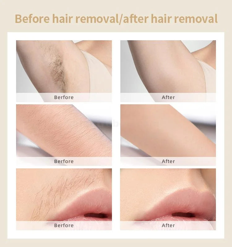 IPL Hair Removal جهاز نزع الشعر IPL
